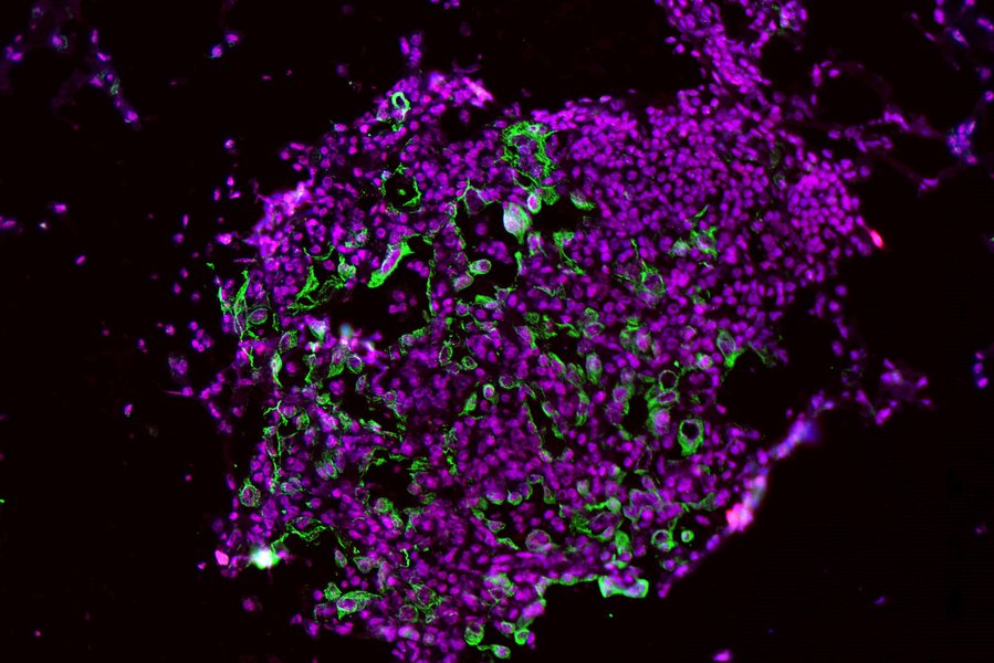 Células de tumor pulmonar con altos niveles de caspase-1